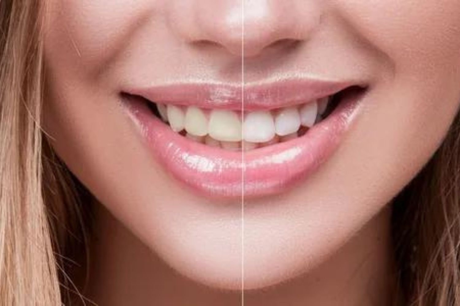 Dental Services- Smile Makeover